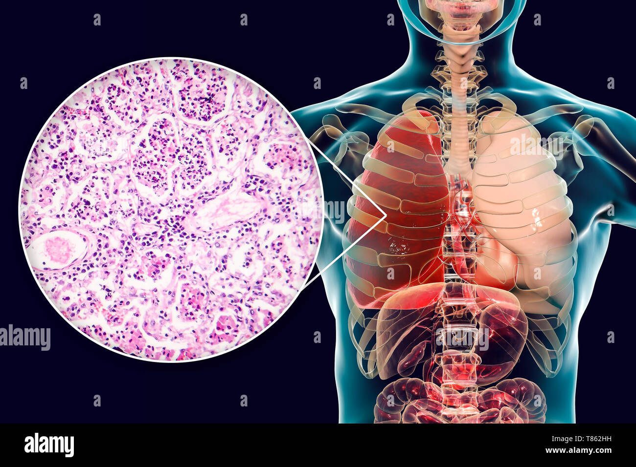 La pneumonie lobaire, illustration et lumière microphotographie Banque D'Images