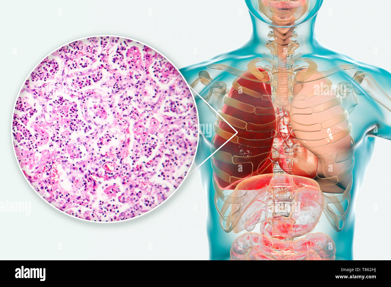 La pneumonie lobaire, illustration et lumière microphotographie Banque D'Images