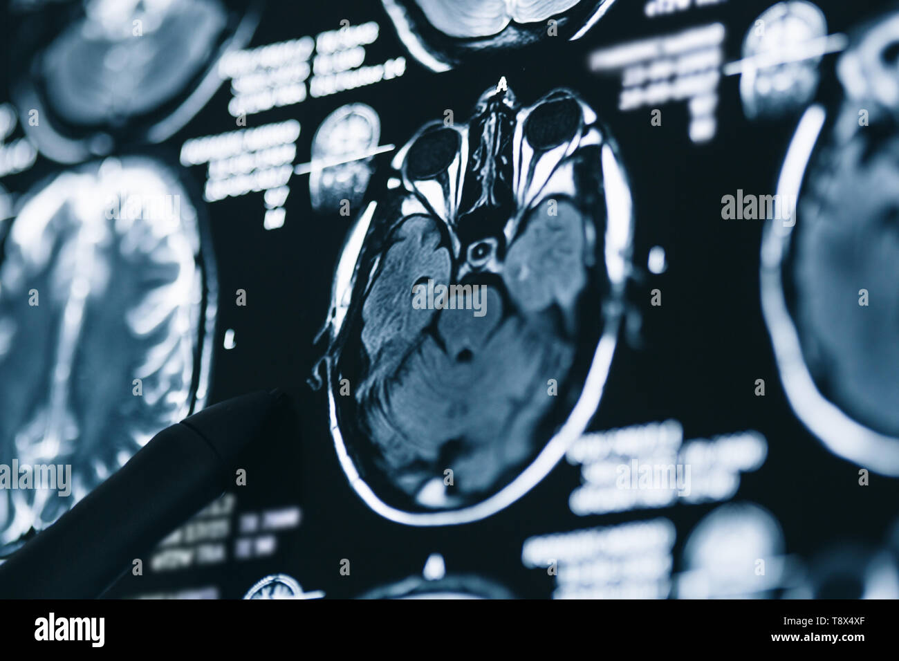 Analyse par résonance magnétique du cerveau. L'IRM scanner de la tête — free download