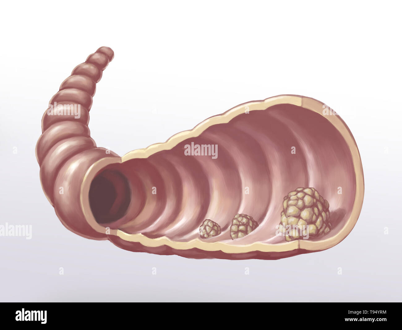 Illustration de polypes dans l'intestin. Un polype est une croissance anormale de tissu fixée au centre d'une muqueuse. Banque D'Images