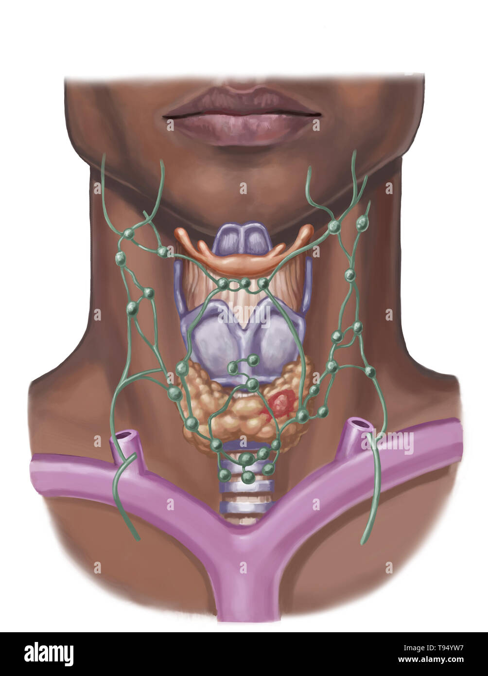 Illustration d'un nodule thyroïdien (en rouge). Ces nodules affectent principalement les femmes et sont pour la plupart bénignes, mais besoin d'être regardé. Banque D'Images