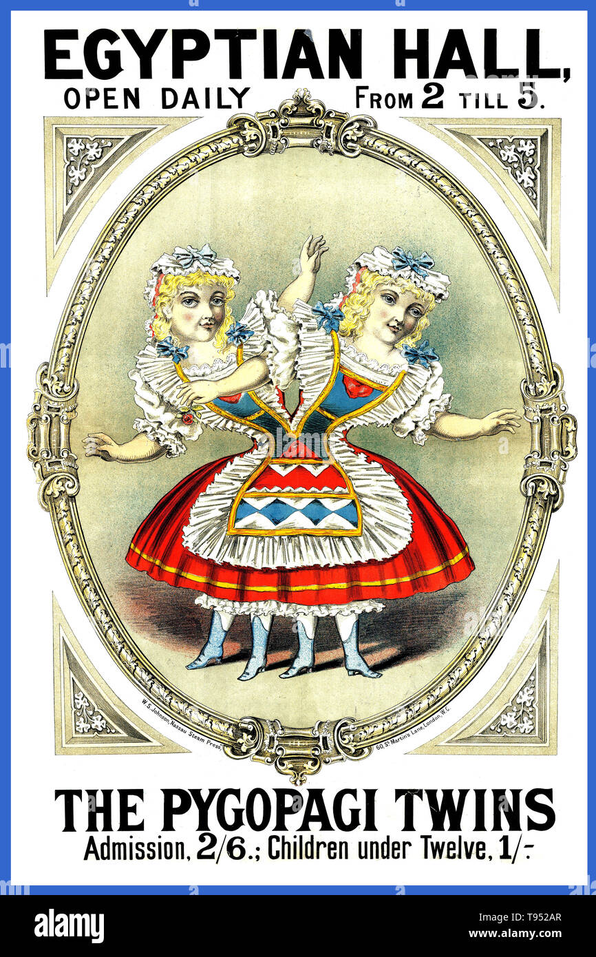 Intitulé : 'Egyptian Hall, ouvert tous les jours de 2 à 5 : Les jumeaux. Pygopagi' jumeaux siamois sont de vrais jumeaux nés avec leur corps s'est joint à un moment et d'avoir plus ou moins de résidus de duplication, un résultat de la division incomplète de l'ovule à partir de laquelle les jumeaux mis au point. Un phénomène extrêmement rare, l'occurrence est estimée à 1 à 49 000 naissances vivantes pour 1 189 000 naissances vivantes, en un peu plus d'incidence dans le sud-est de l'Asie et l'Afrique. Environ la moitié sont mort-nés, et un autre tiers meurent dans les 24 heures. La plupart des naissances vivantes sont de sexe féminin, avec un ratio de 3:1. Banque D'Images