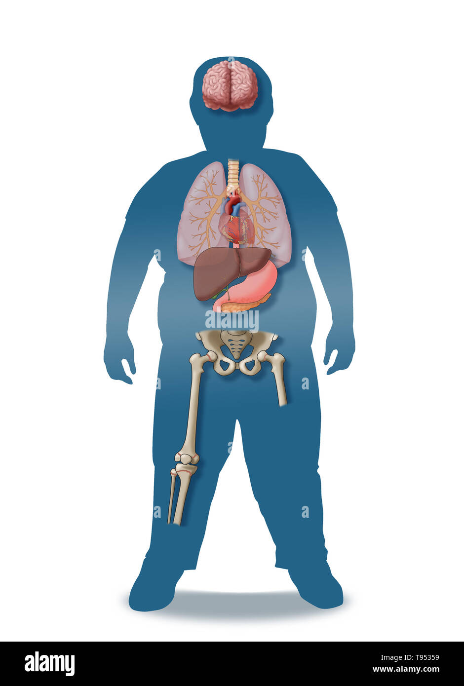 Une illustration de les conséquences médicales de l'obésité chez les enfants. Banque D'Images