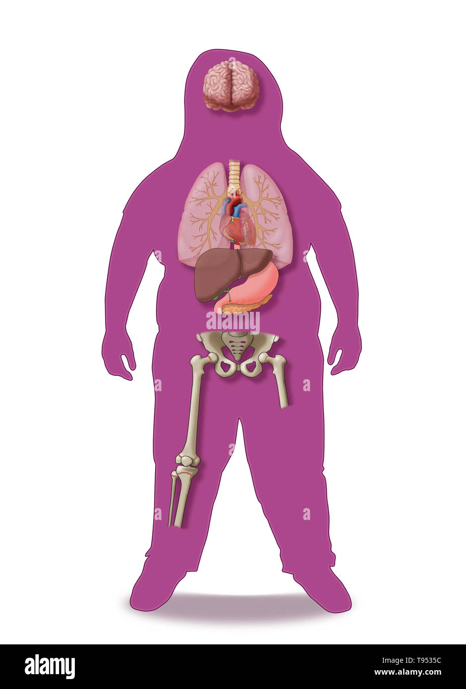 Une illustration de les conséquences médicales de l'obésité chez les enfants. Banque D'Images