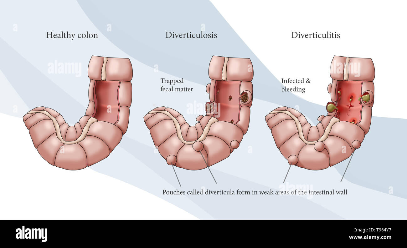 Illustration en comparant l'aspect d'un côlon sain (gauche) ; diverticulose (milieu) ; et la diverticulite (droite). Banque D'Images