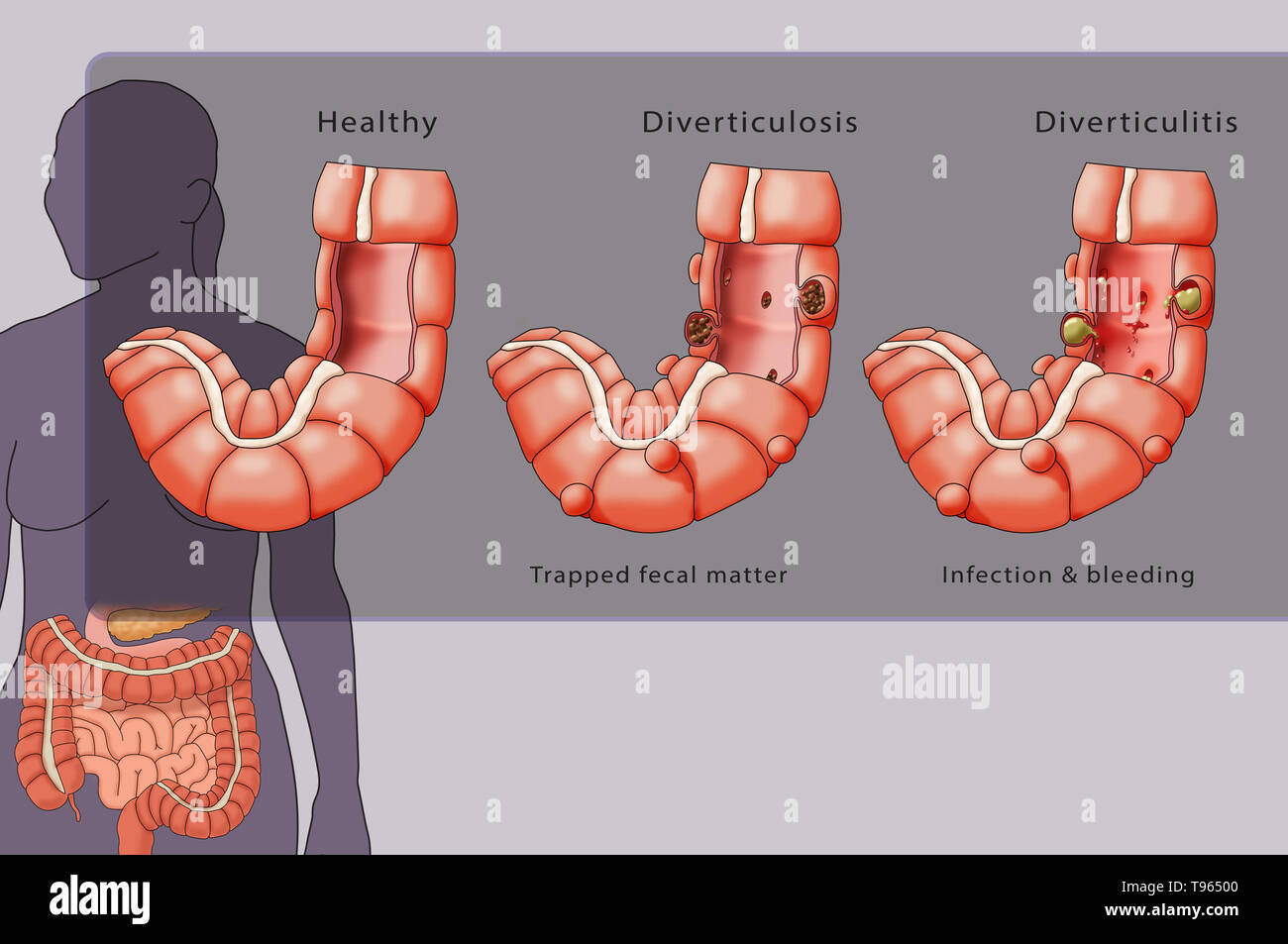 Illustration en comparant l'aspect d'un côlon sain (gauche), diverticulose (milieu), et la diverticulite (droite) ; une silhouette féminine avec le système digestif est mis en évidence dans l'arrière-plan. Banque D'Images
