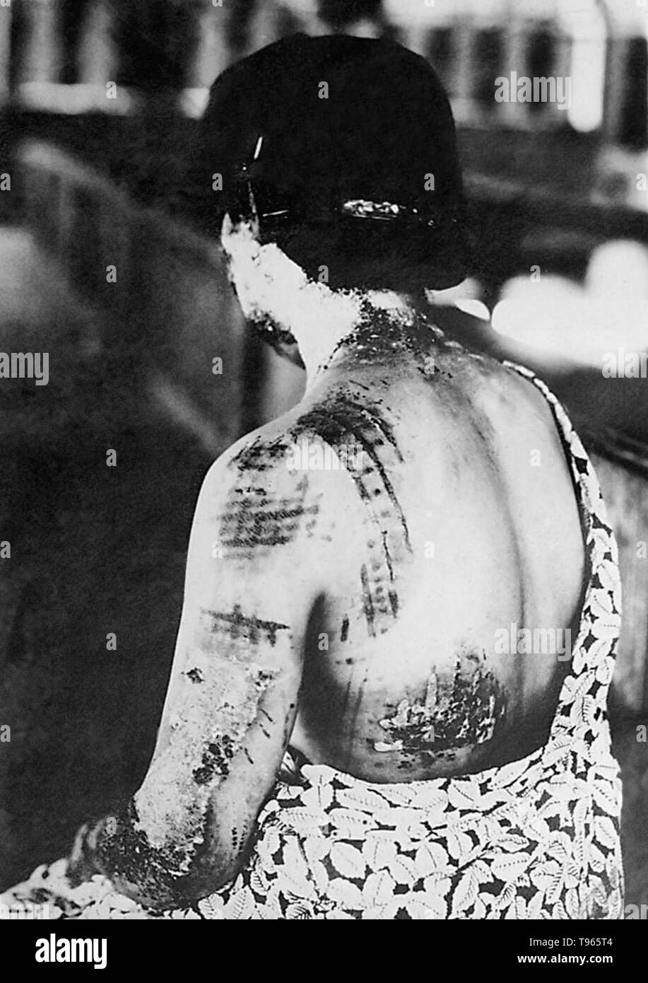 Le 6 août 1945, près de la fin de la Seconde Guerre mondiale, les États-Unis ont abandonné une bombe atomique sur la ville japonaise d'Hiroshima, détruisant la ville et tuant plus de 70 000 personnes. Dans cette image à partir d'un rapport médical de l'attentat de couleur sombre, le modèle d'une vetements femme est montré pour avoir absorbé de l'énergie thermique et brûlé la peau, surtout autour de plus d'un sous-domaines, comme les épaules. Banque D'Images