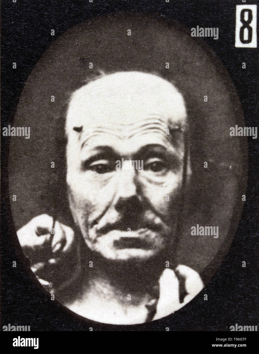 L'expression du visage de l'attention sur le visage humain d'être induits par les courants électriques. Guillaume-Benjamin Duchenne de Boulogne-Amand (17 septembre 1806 - 15 septembre 1875) est un neurologue français qui a permis à la science de l'électrophysiologie. Influencé par les croyances de physionomie, la dystrophie voulait déterminer comment les muscles dans le visage humain produisent des expressions du visage qu'il croyait être directement liée à l'âme de l'homme. Banque D'Images