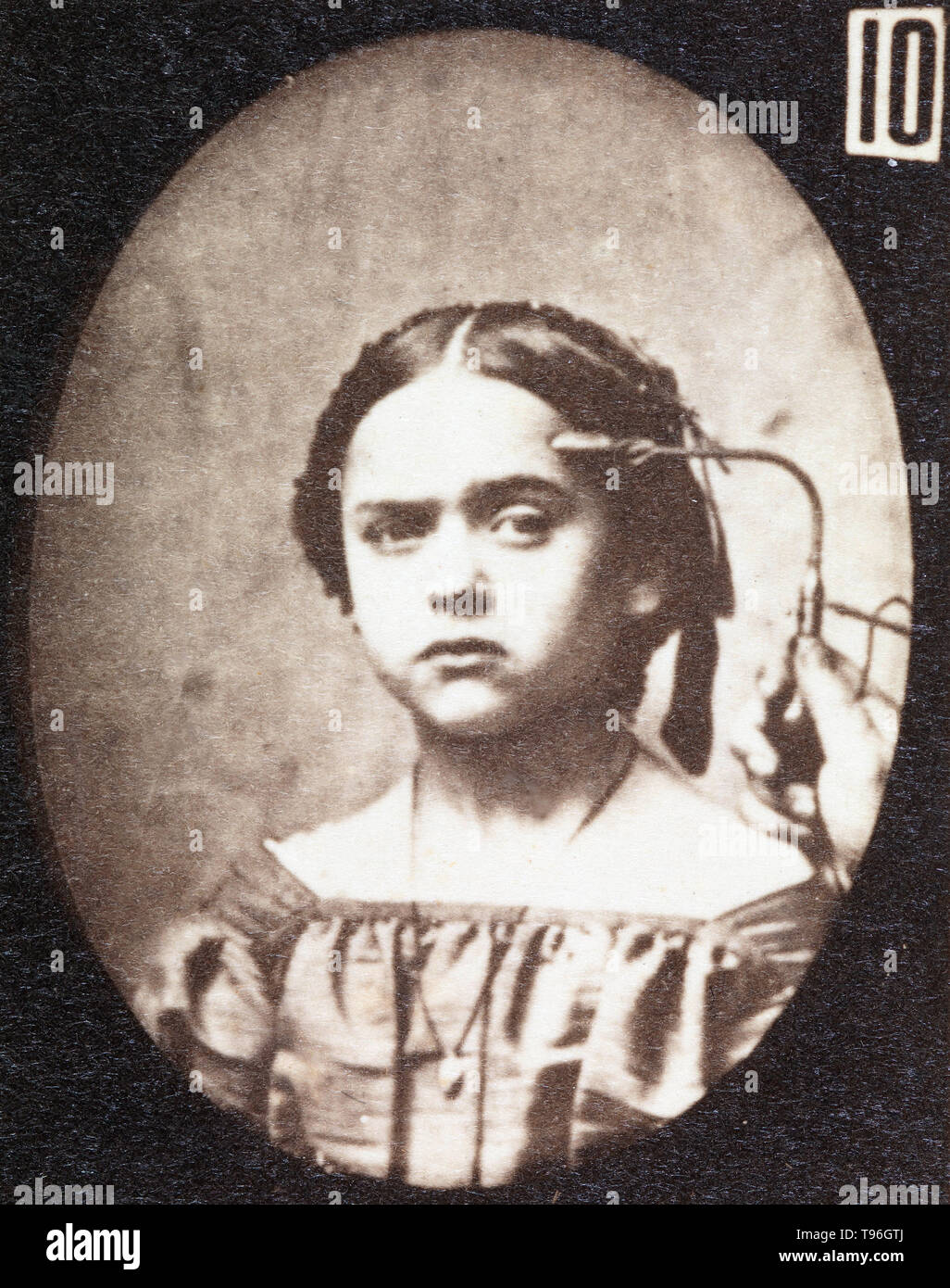L'expression du visage de l'attention sur le visage humain d'être induits par les courants électriques. Guillaume-Benjamin Duchenne de Boulogne-Amand (17 septembre 1806 - 15 septembre 1875) est un neurologue français qui a permis à la science de l'électrophysiologie. Influencé par les croyances de physionomie, la dystrophie voulait déterminer comment les muscles dans le visage humain produisent des expressions du visage qu'il croyait être directement liée à l'âme de l'homme. Banque D'Images