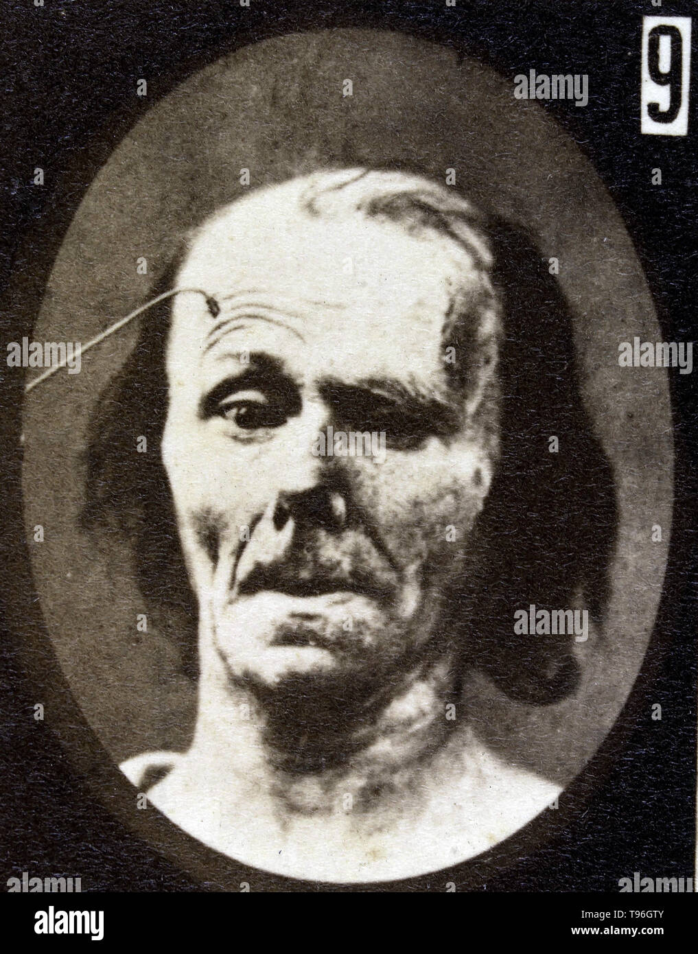L'expression du visage de l'attention sur le visage humain d'être induits par les courants électriques. Guillaume-Benjamin Duchenne de Boulogne-Amand (17 septembre 1806 - 15 septembre 1875) est un neurologue français qui a permis à la science de l'électrophysiologie. Influencé par les croyances de physionomie, la dystrophie voulait déterminer comment les muscles dans le visage humain produisent des expressions du visage qu'il croyait être directement liée à l'âme de l'homme. Banque D'Images