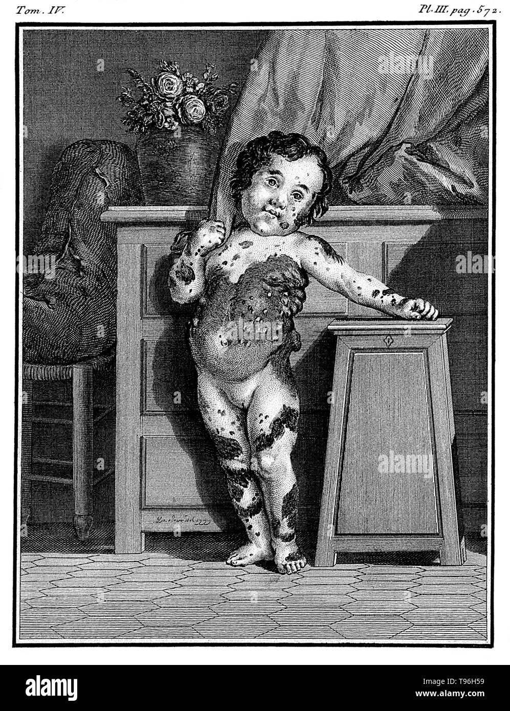 Comte de Buffon : Histoire Naturelle. Maria Herig, une fille avec une maladie de peau identifiés comme plusieurs fibromes. L'Histoire Naturelle, générale et particulière, avec la description du Cabinet du Roi (l'Histoire Naturelle, général et particulier, avec une description de l'Cabinet du Roi) est une collection encyclopédique de 36 grandes (quarto) volumes écrits entre 1749-1804 par le Comte de Buffon, et continué dans huit autres volumes après sa mort par ses collègues. Banque D'Images