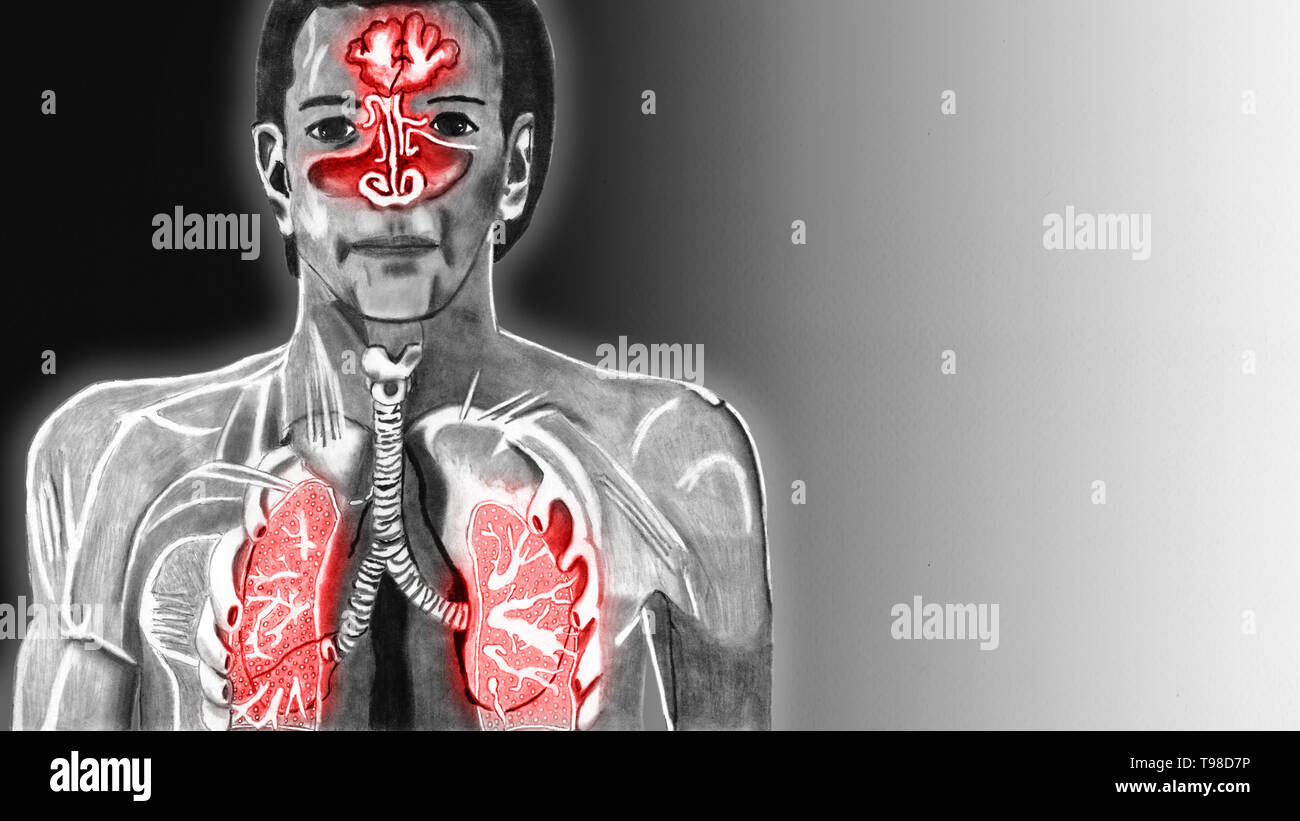 Vue interne de l'appareil respiratoire chez l'homme. Les voies aériennes supérieures sont enflammées et donc rouge. Illustration tirée d'un crayon. Banque D'Images