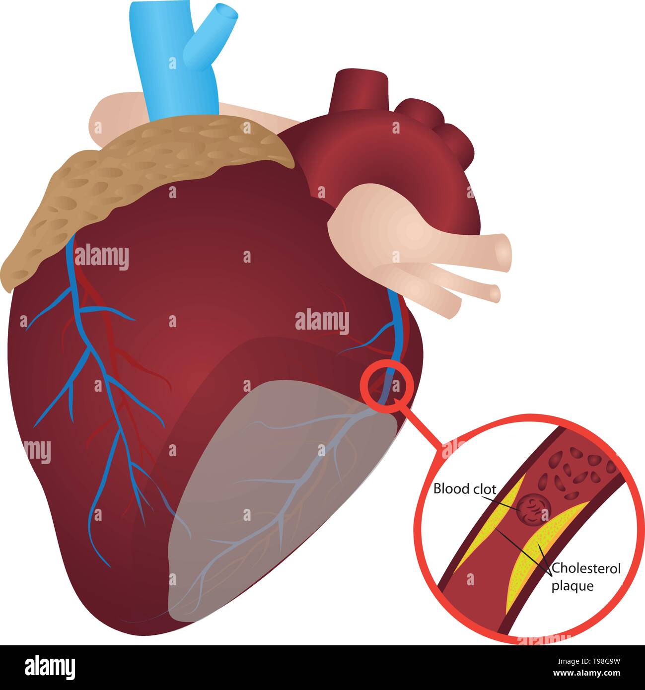 Caillot de sang dans la plaque de cholestérol Crise cardiaque artère vector illustration Illustration de Vecteur