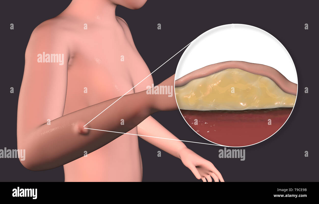 Lipome, illustration Banque D'Images