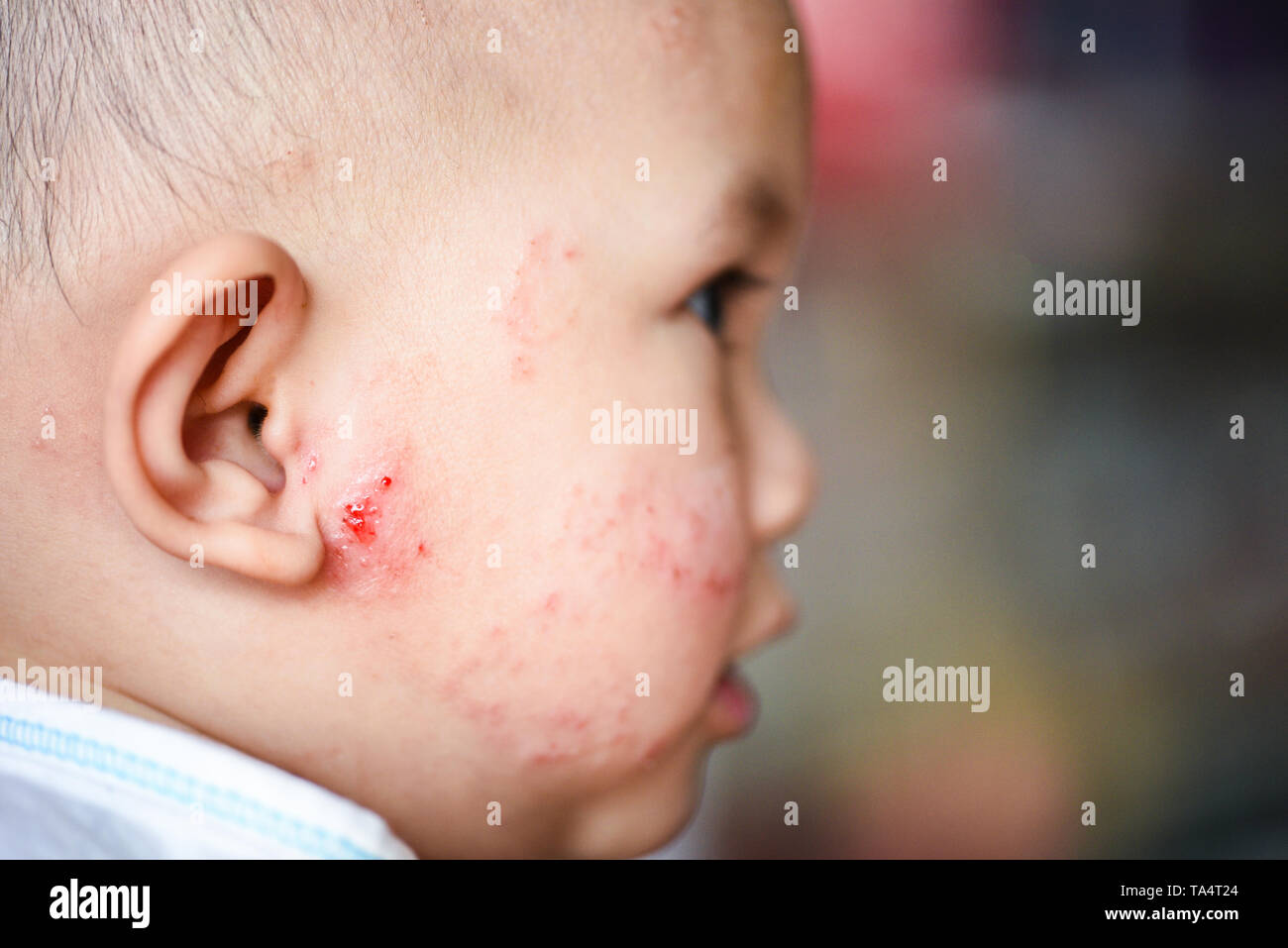 Baby eczema Banque de photographies et d’images à haute résolution Page 2 Alamy