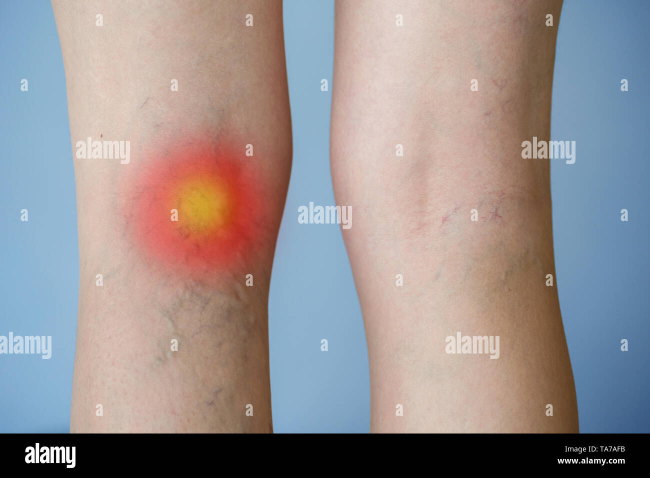 Varices de la jambe avec un point rouge. La médecine, les soins de