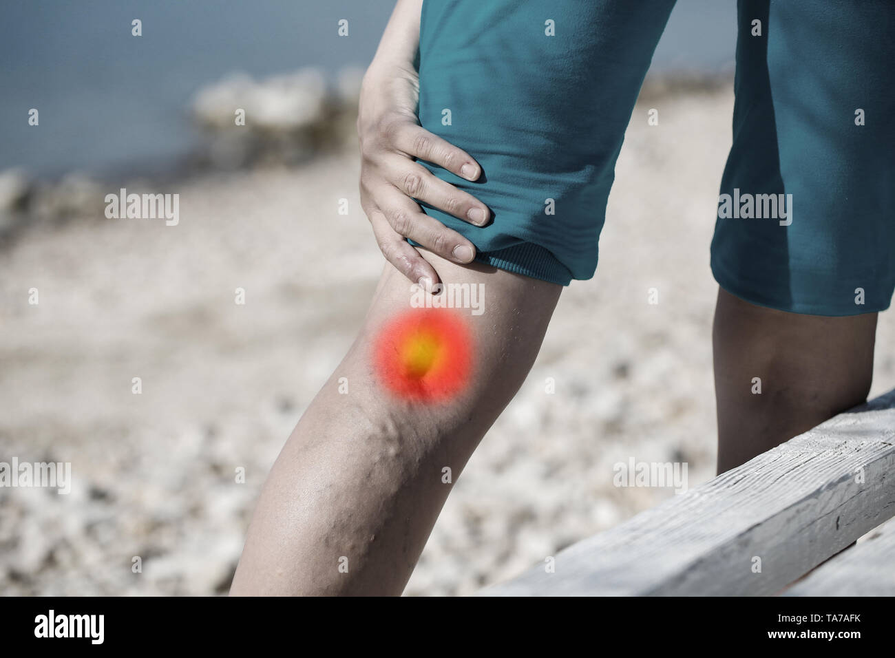 Woman touching varices douloureuses sur une jambe avec un point rouge. Concept de soins de santé. Banque D'Images