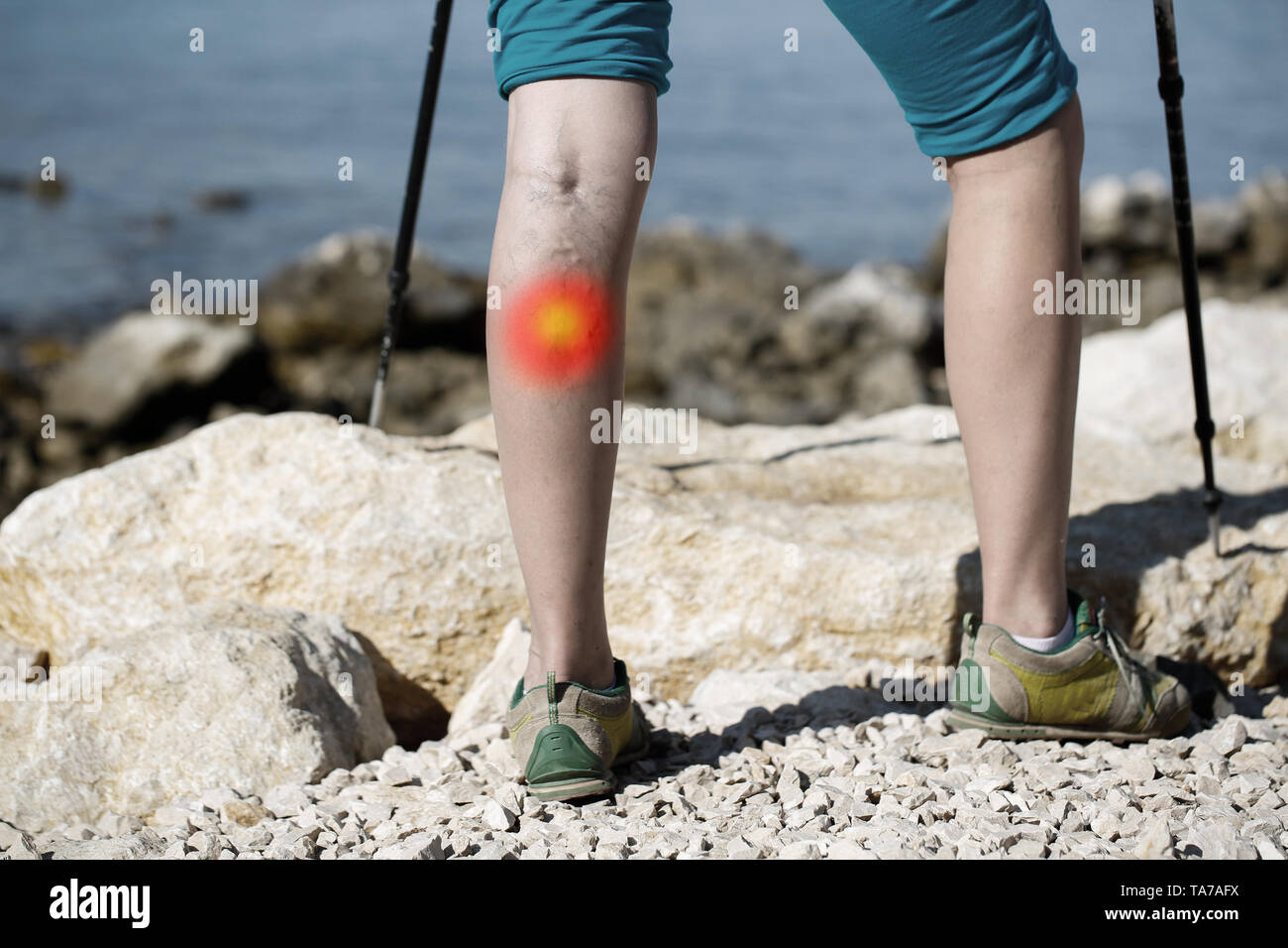 Femme avec des varices sur une jambe à l'aide de bâtons de marche à pied. Point rouge effet. Banque D'Images