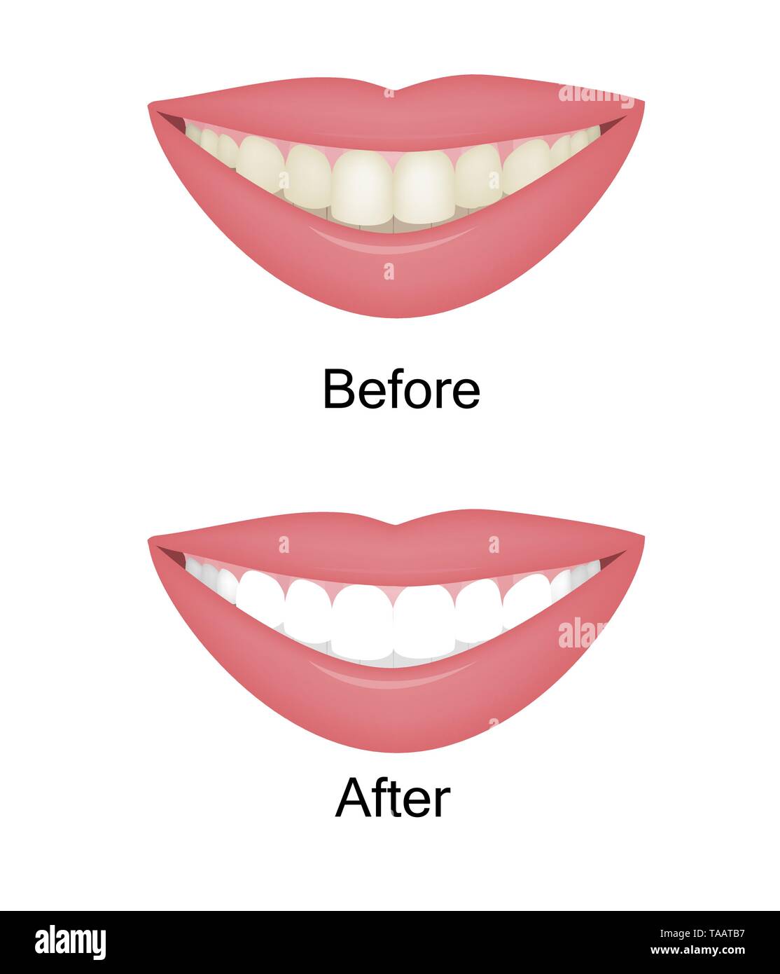 Le blanchiment des dents avant et après. Illustartion vecteur Illustration de Vecteur Le blanchiment des dents avant et après. Illustartion vecteur Illustration de Vecteur