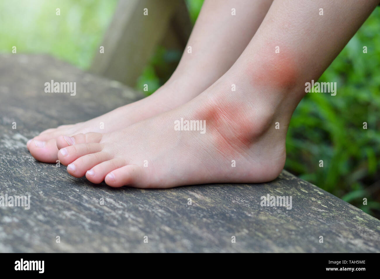 Close up Réactions allergiques de peau à partir de la piqûre de moustique sur petite fille jambe quand son jeu dans le parc de jeux Banque D'Images