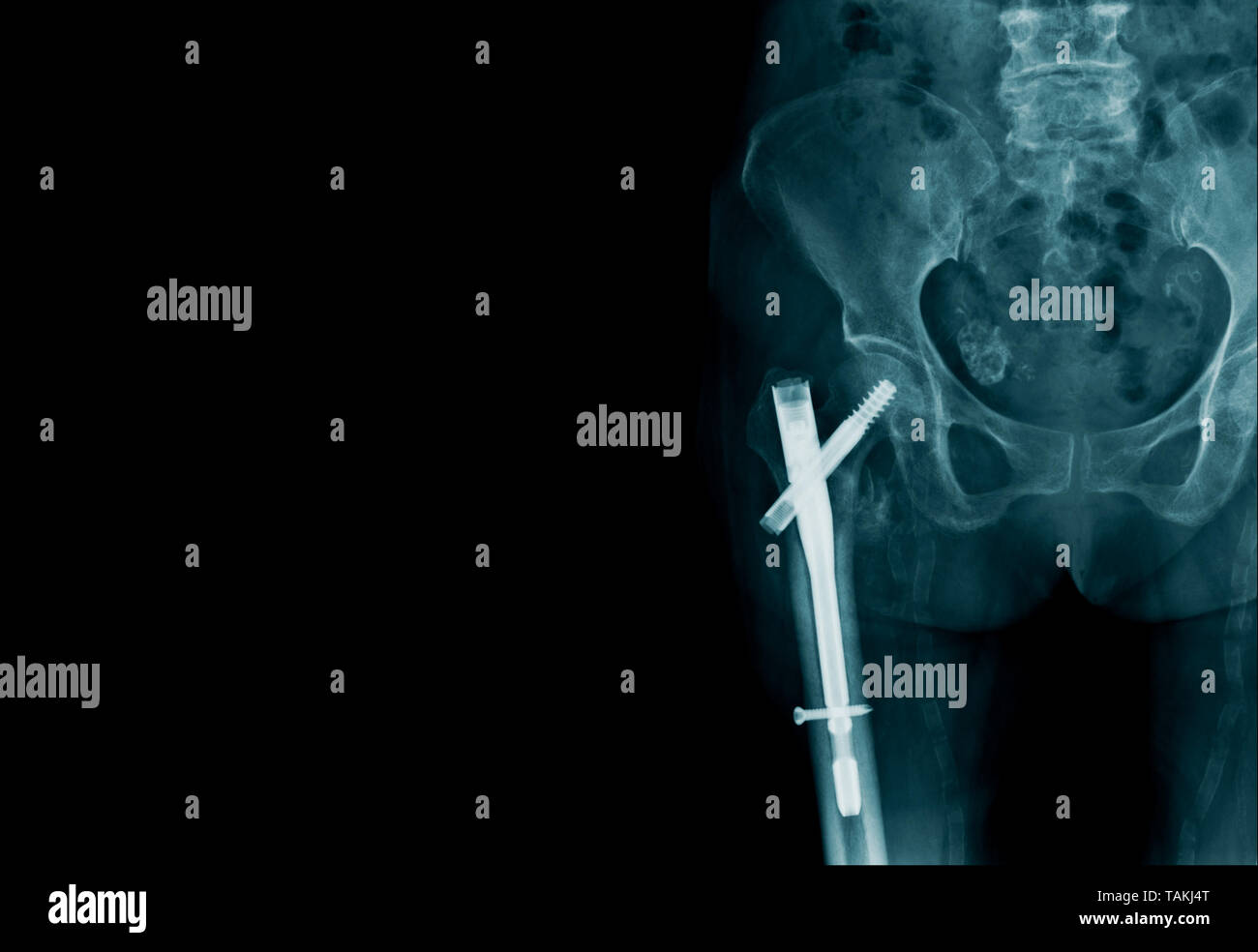 X-ray image fracture de la hanche ou intertrochanteric fracture et publiez la fixation interne, Y-dispositif de fixation interne percutanée béquille Banque D'Images