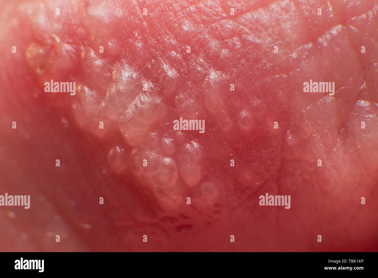 Boutons De Fievre Banque D Image Et Photos Alamy Boutons De Fievre Banque D Image Et Photos Alamy
