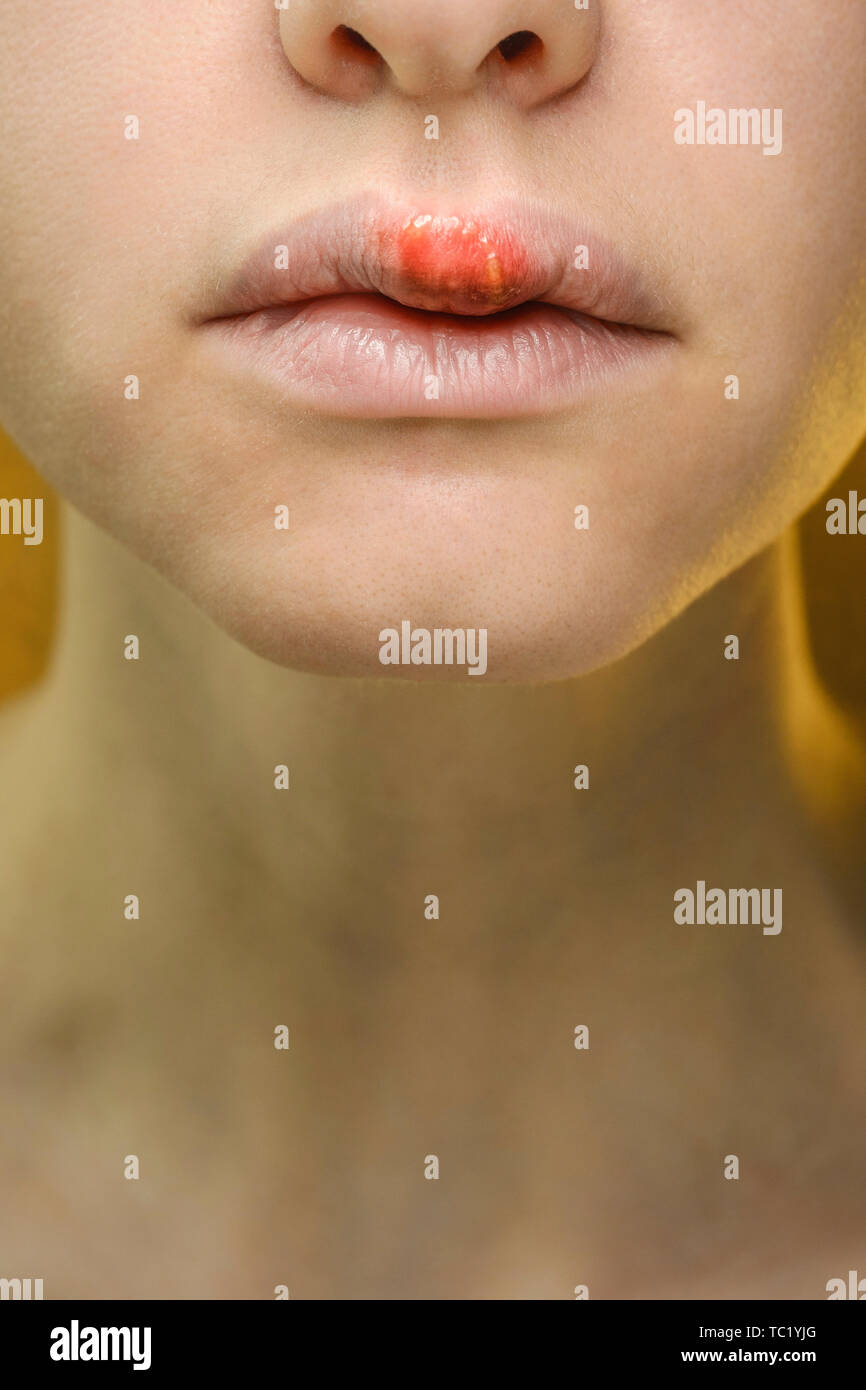 Lèvre enflée Banque de photographies et d’images à haute résolution Alamy