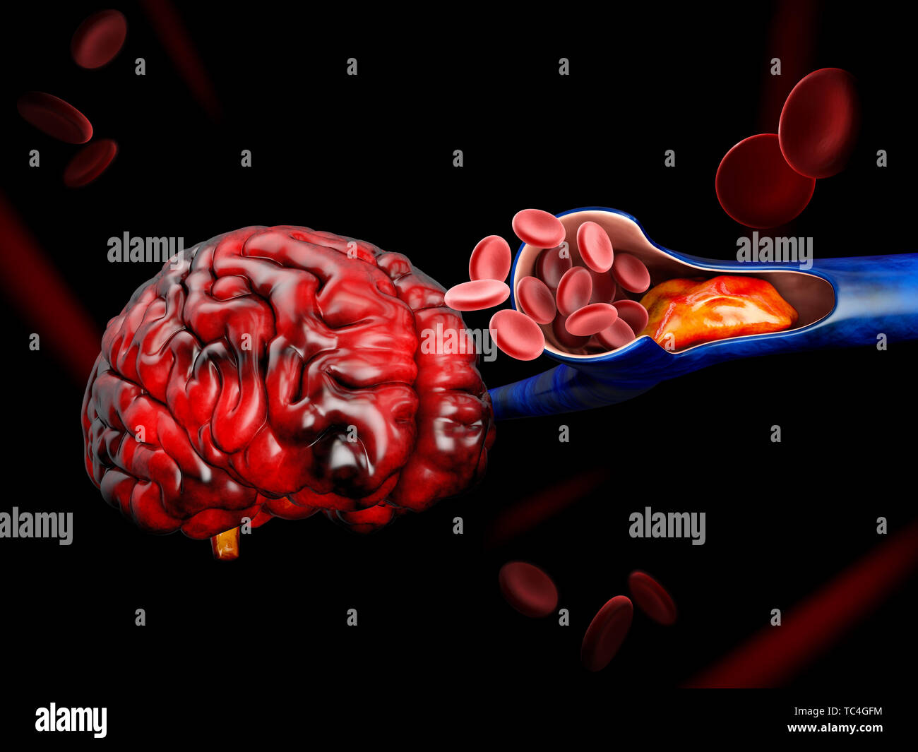3d illustration de la thrombose veineuse profonde ou des caillots de sang. L'embolie. Banque D'Images