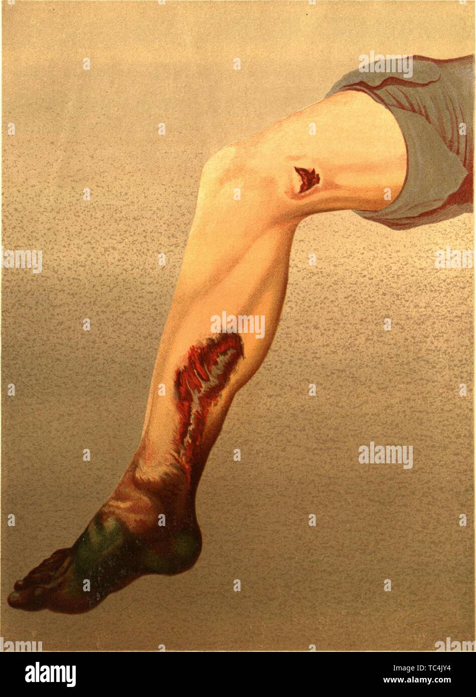 Gravure d'une jambe humaine infectée par la gangrène à la suite d'une blessure par balle de lacération de l'artère fémorale, du livre 'L'histoire médicale et chirurgicale de la guerre de la rébellion' par U.S. Army Surgeon General's Office, 1883. Avec la permission de Internet Archive. () Banque D'Images Gravure d'une jambe humaine infectée par la gangrène à la suite d'une blessure par balle de lacération de l'artère fémorale, du livre 'L'histoire médicale et chirurgicale de la guerre de la rébellion' par U.S. Army Surgeon General's Office, 1883. Avec la permission de Internet Archive. () Banque D'Images