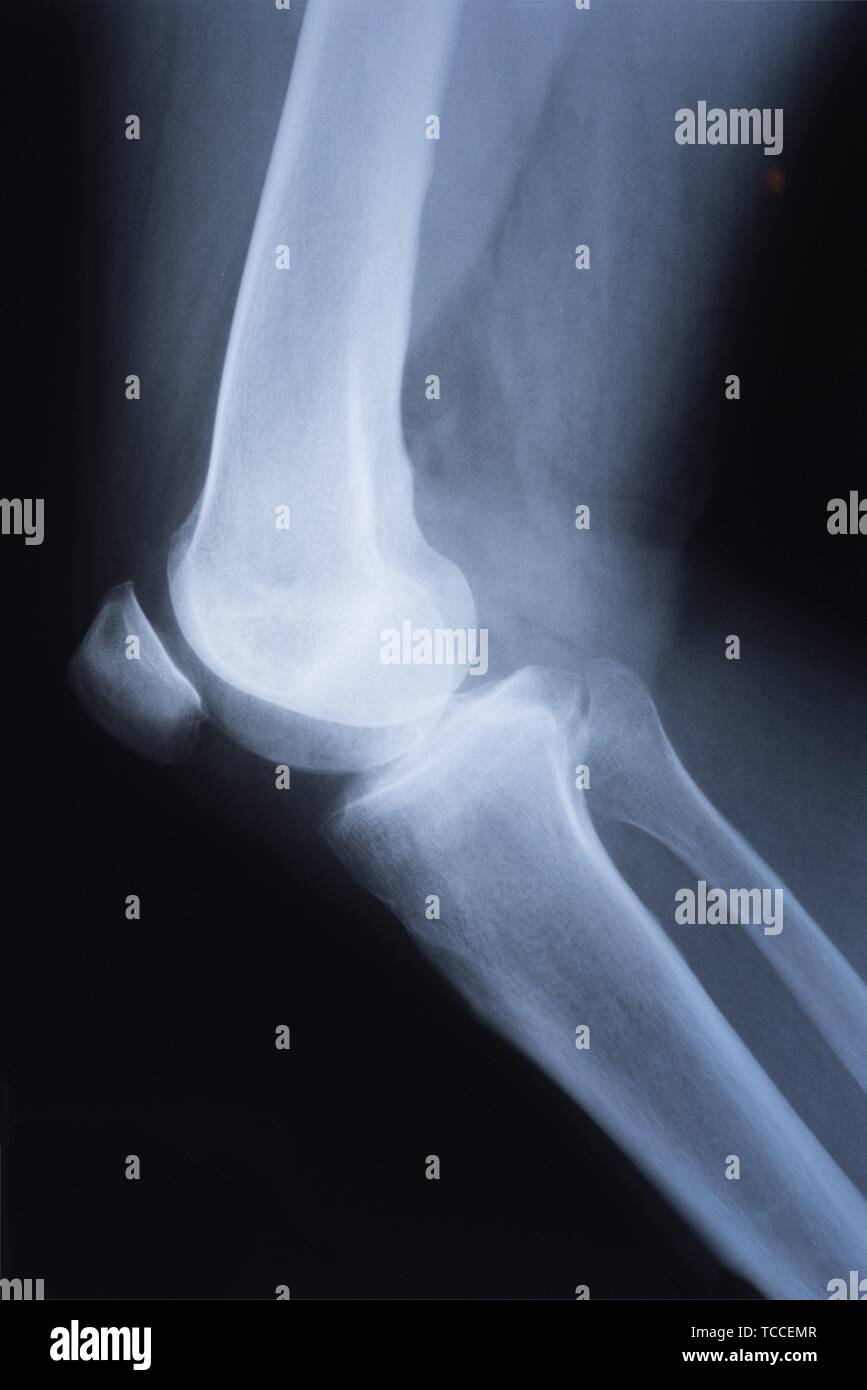 Medical X-ray image de genou. La radiographie. Banque D'Images