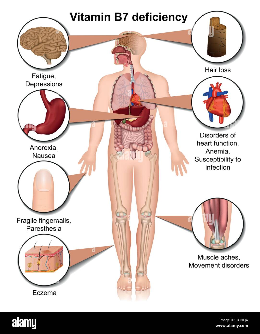 La carence en vitamine B7 vector illustration médicale isolé sur fond blanc infographie Illustration de Vecteur