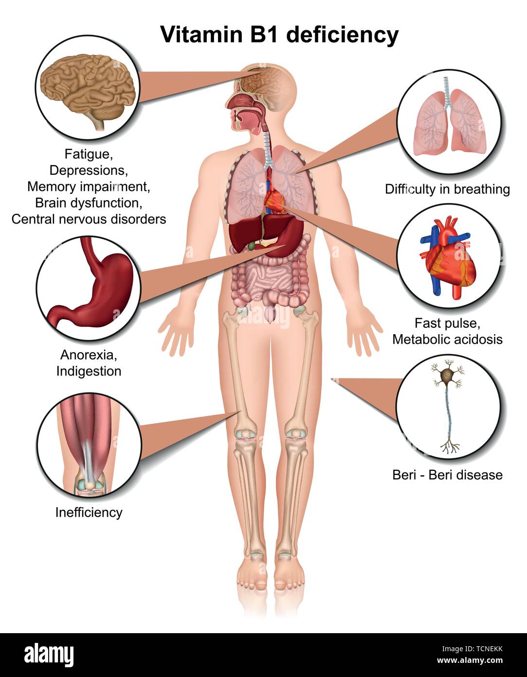 La carence en vitamine B1 3d medical vector illustration infographie sur fond blanc la thiamine Illustration de Vecteur