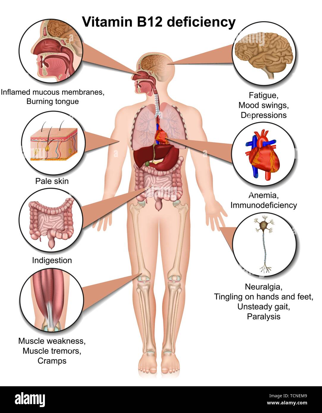 Une carence en vitamine B12, infographie, 3d medical vector illustration sur fond blanc Illustration de Vecteur