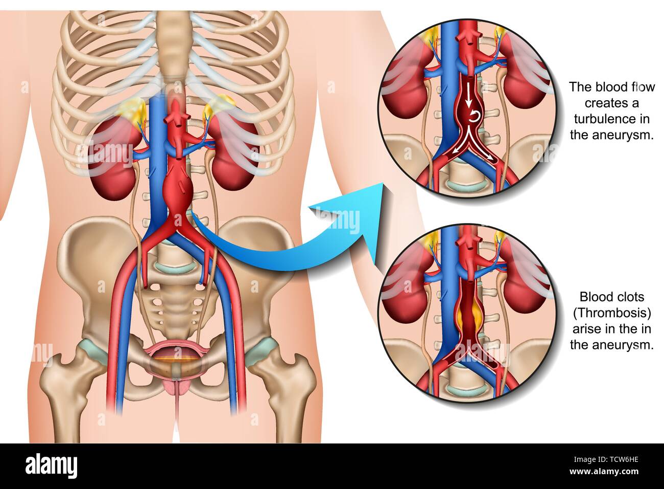 Description de l'anévrisme abdominal vector illustration médicale sur fond blanc Illustration de Vecteur