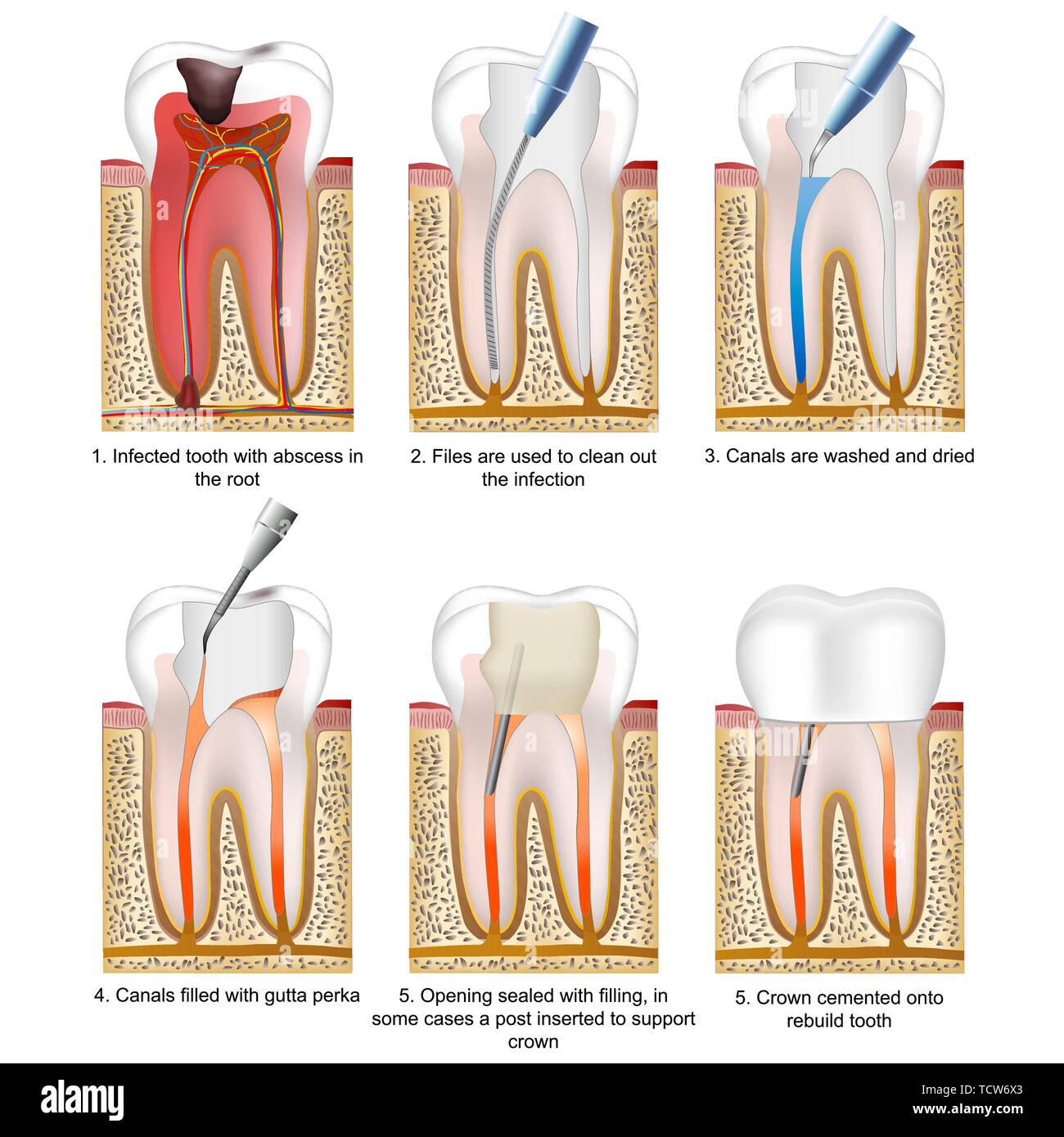 Détruit la carie avec une dent ou un processus d'illustration vectorielle, remplissage des dents Illustration de Vecteur