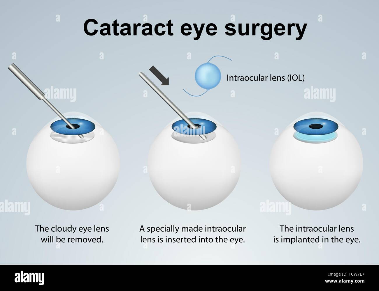 La chirurgie des yeux cataracte vector illustration médicale processus isolé sur fond gris eps 10 Infographie Illustration de Vecteur