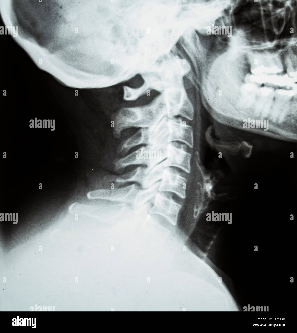 Radiographie d'un cou et de la tête Photo Stock - Alamy