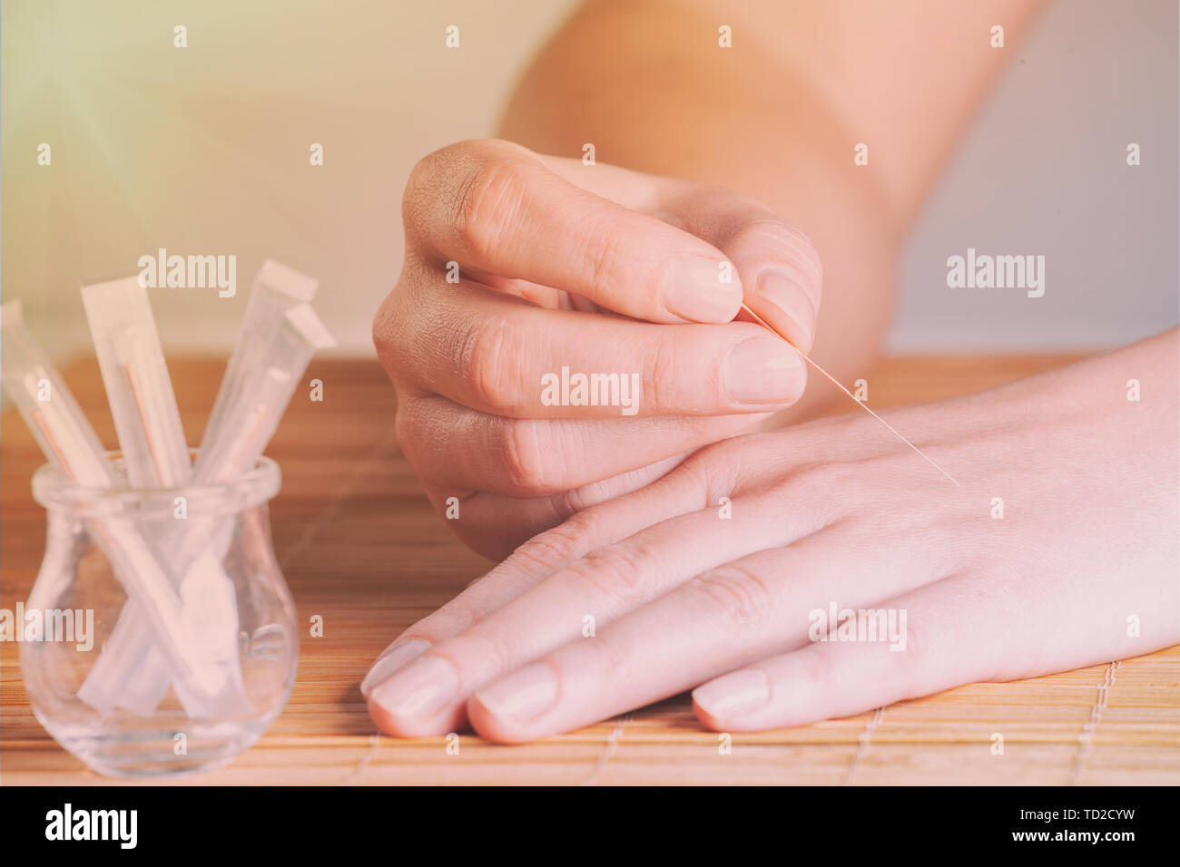 L'application de l'acupuncture aiguille dans la main Banque D'Images