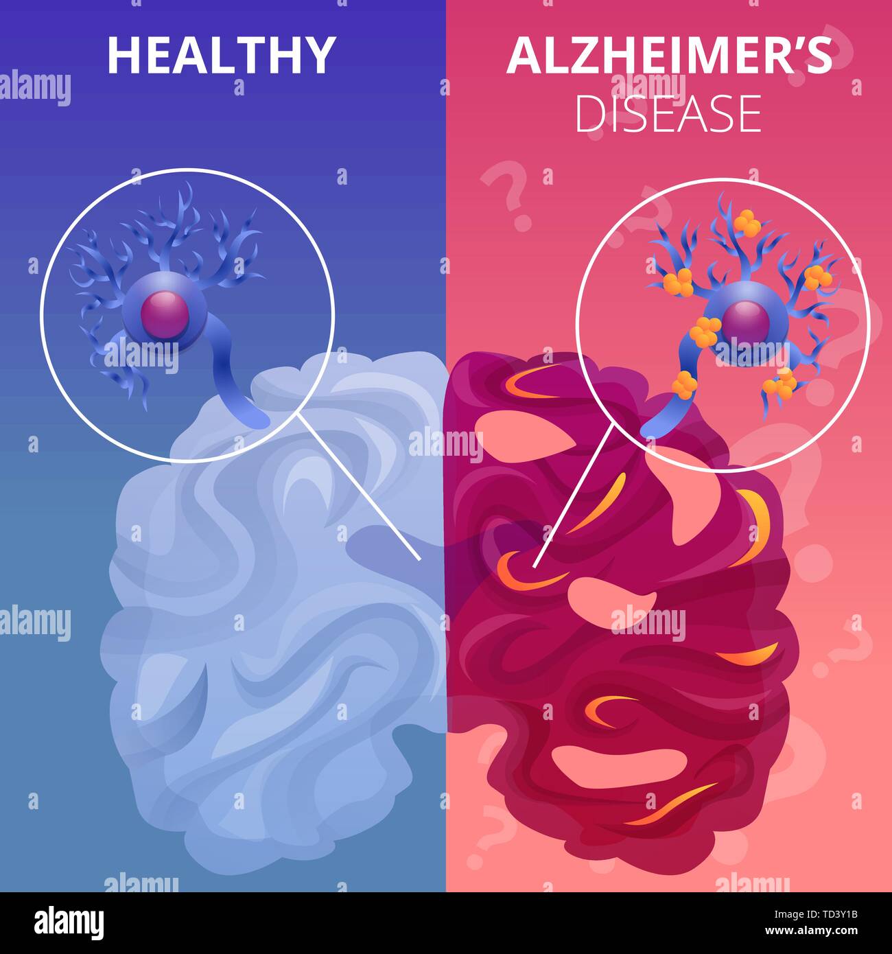 Cerveau Alzheimer Banque d'images vectorielles - Alamy