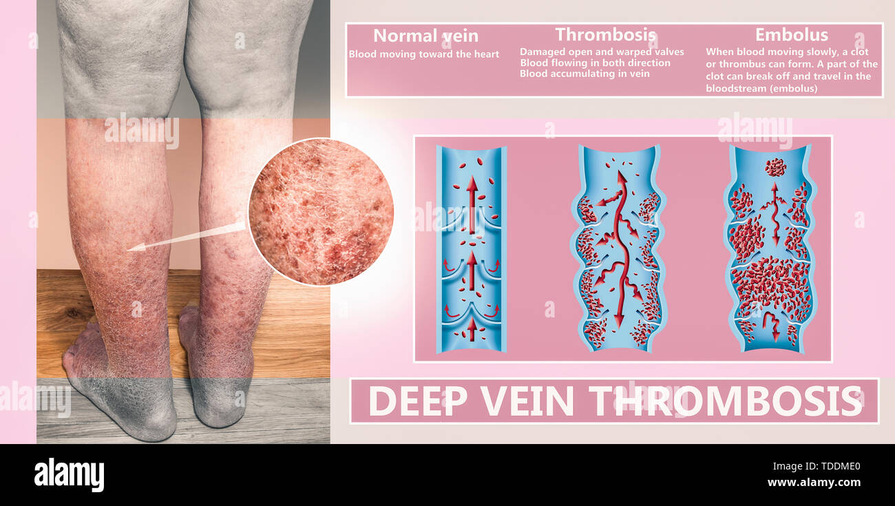 Membre inférieur hyperpigmentées secondaire à l'insuffisance veineuse. Banque D'Images