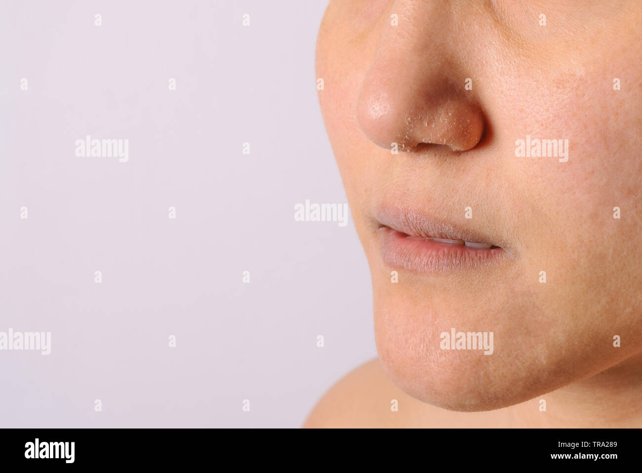 Les femmes ont de l'eczéma allergique Nez et lèvres sèches sur l'hiver  libre Photo Stock - Alamy
