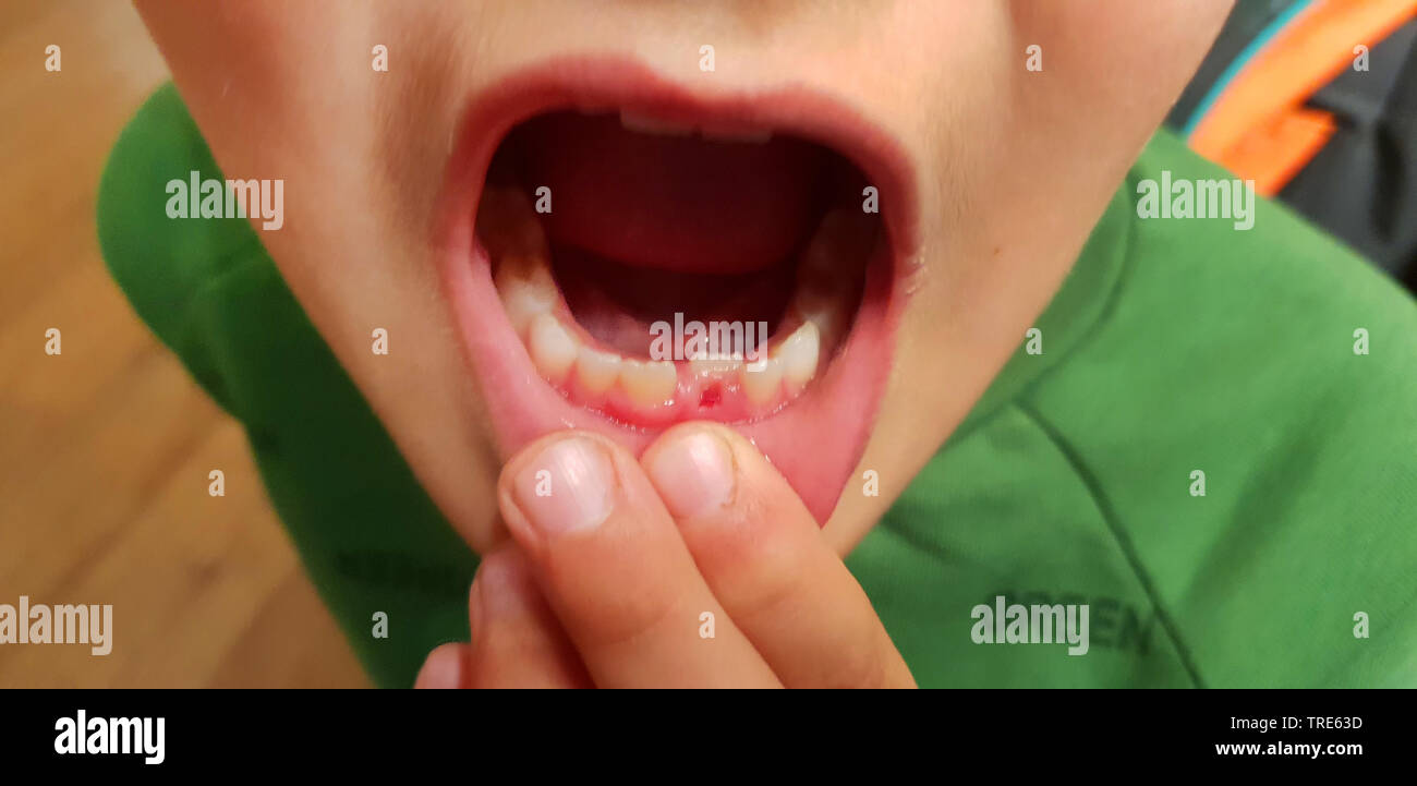 Les dents du bas d'un petit garçon, montrant une perte de dent primaire, Allemagne Banque D'Images