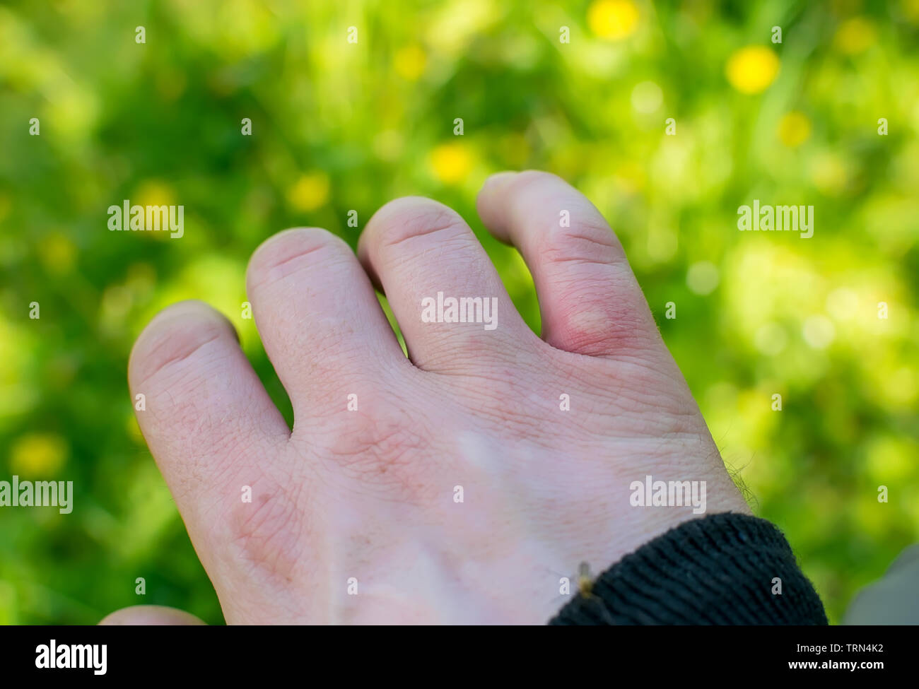 Plaie, blessure d'une piqûre de moustique sur un doigt dans la forêt dans la nature Banque D'Images