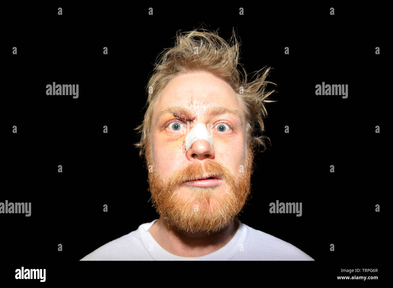 Homme avec un nez cassé et des points de suture sur un fond noir Banque D'Images
