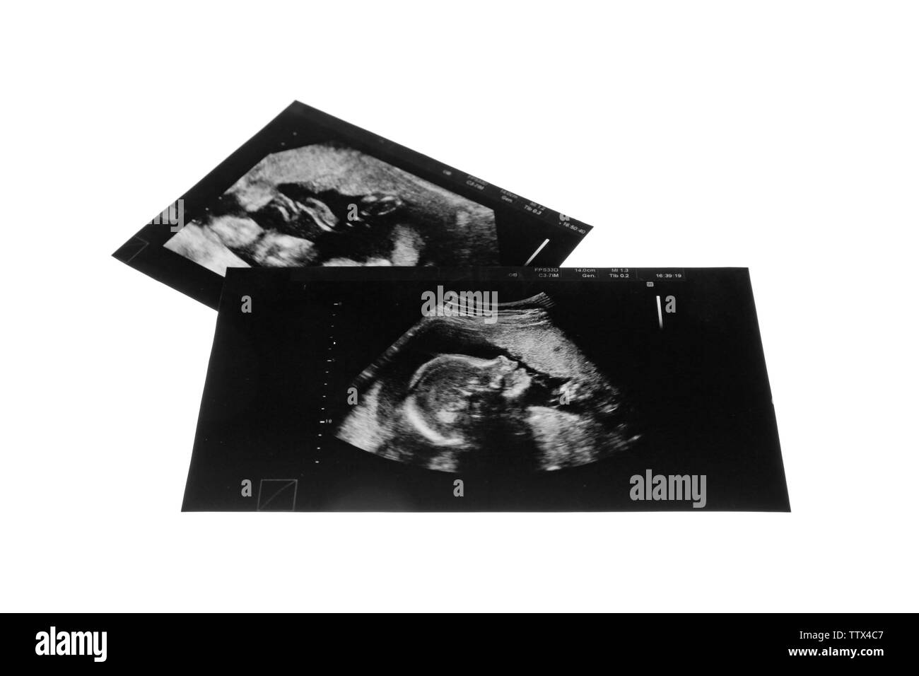 Photos d'échographie de bébé sur fond blanc Banque D'Images