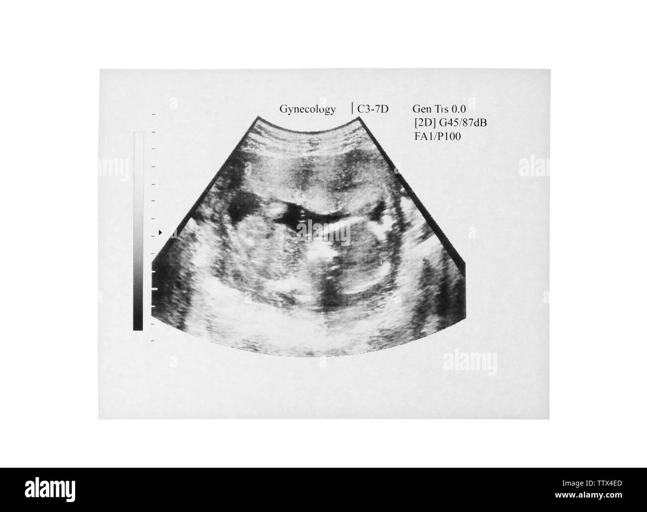 Photo d'échographie de bébé sur fond blanc Banque D'Images