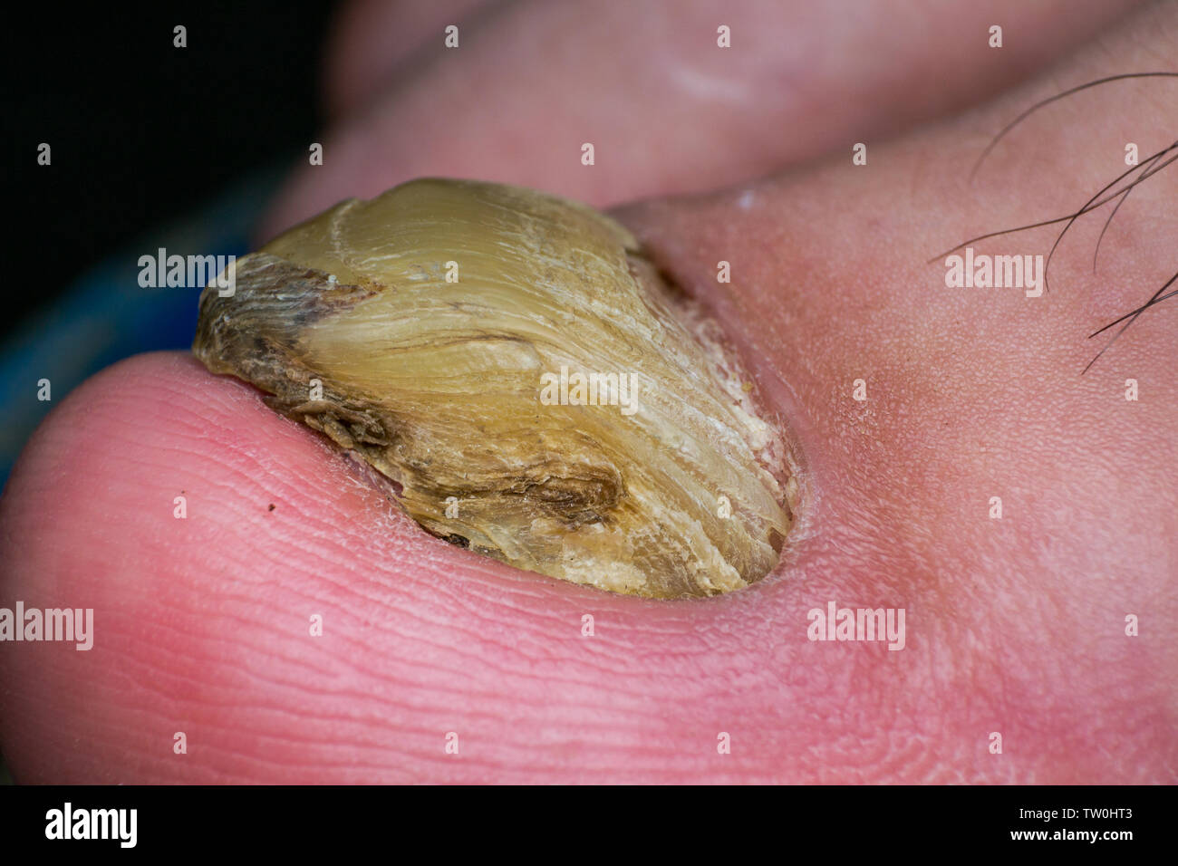 Photo macro d'un ongle humain avec des champignons Banque D'Images
