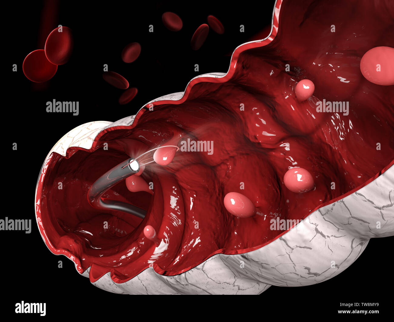 3d illustration de l'enlèvement d'un polype colique avec une boucle de fil électrique au cours d'une coloscopie Banque D'Images