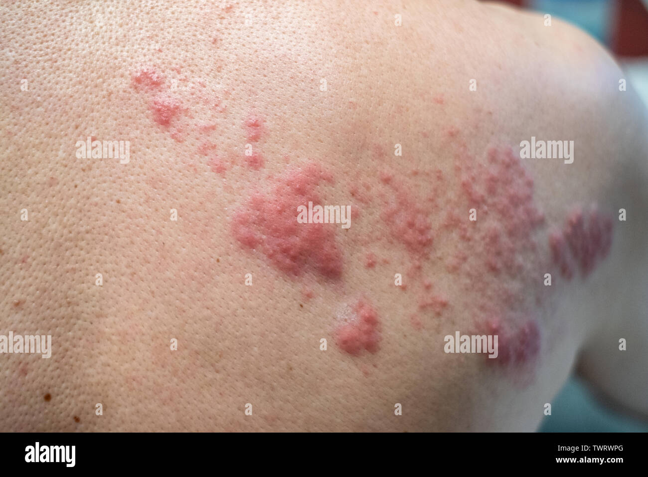 Infection de la peau cloques herpes Banque de photographies et d’images à haute résolution Alamy