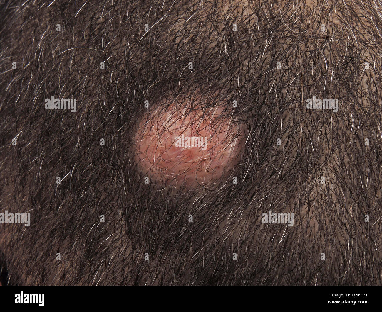Loupe du cuir chevelu Photo Stock - Alamy